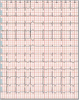 A diabetic patient increased premature ventricular contractions after using liraglutide: a case report